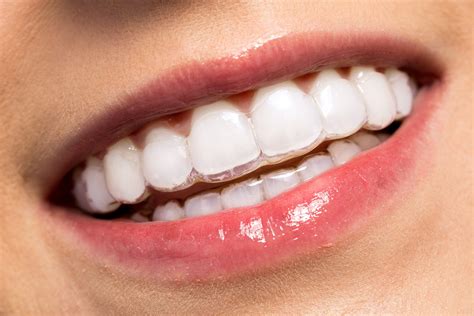 4 Best Invisible Braces and Teeth Aligners for Adults